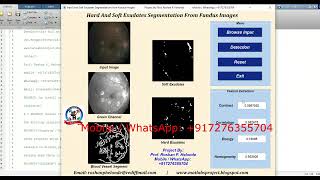 Detection of Hard Exudates And Soft Exudates In Fundus Images Using Matlab For Diabetic Retinopathy