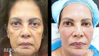 Bhavna Looks 10-15 Years Younger | Watch Her Reaction After Face Fat Transfer | DR SW Clinics