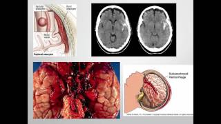 Stroke/CVA