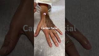 Carbon Hand Rejuvenation