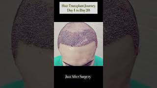 Hair Transplant Results #Hair #hairtransformation #shorts #trending