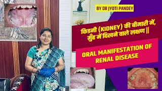 किडनी (kidney) की बीमारी में ,मुँह में दिखने वाले लक्षण || oral manifestation of Renal disease..