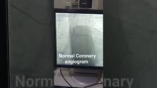 Normal Coronary angiogram