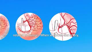 Bariatric embolization │Unique Interventional Radiology