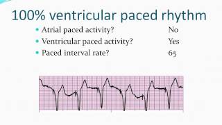 EKG review part 1