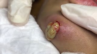 Big Cystic Acne Blackheads Extraction Blackheads & Milia, Whiteheads Removal Pimple Popping #PA286