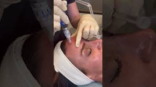 SkinPen Microneedling with Exosomes Regenerative Complex - Coberly Plastic Surgery & Med Spa