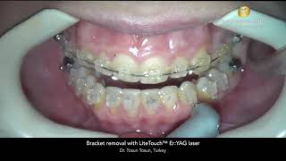 Bracket removal with LiteTouch™ Er YAG laser