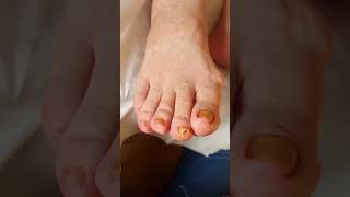 #obcięciepaznokci #pedicuremedyczny #podopogotowie #skracaniepaznokci #toenails #longtoenails