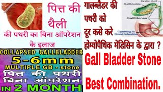 Gall Bladder Stone Best Homoeopathic Medicine Combination//Remove Gall Bladder Stone Without Surgery