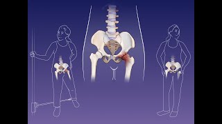 Quick Take: Hip Replacement for Severe Hip Osteoarthritis