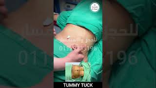 Tummy Tuck With Doctor Mostafa El Okazi | شد ترهلات البطن مع دكتور مصطفى العكازى