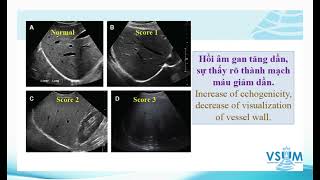 Siêu âm thường quy bệnh lý gan lan toả - BS. NGUYỄN QUANG TRỌNG