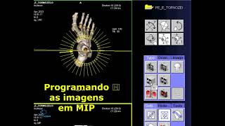 Reconstrução 3D e MIP de Tomografia computadorizada de Pé e Tornozelo