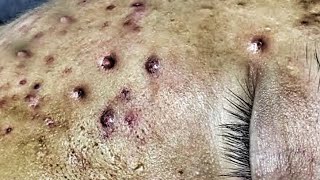 Jericho's Arc Of Pimples