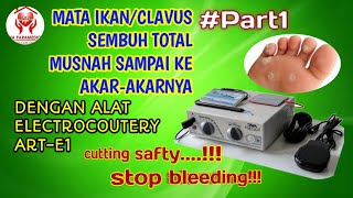 Eksekusi Mata Ikan/Clavus Sembuh Sampai Akar-Akarnya !!!