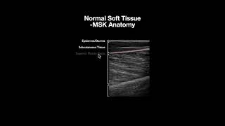 Normal Sonoanatomy of the Musculoskeletal Layers