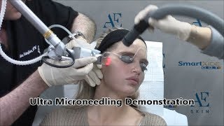 Ultra Microneedling Demonstration 14 - A E Skin - Encino, CA - 818-835-1833