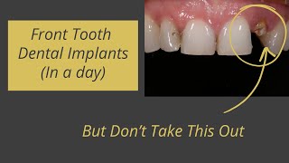 Immediate Dental Implants for Front Teeth (The Quick Way) - One Step Oral Surgery