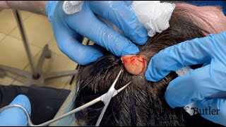 Removal of a Pilar Cyst