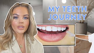 MY TEETH JOURNEY - COMPOSITE VS PORCELAIN VENEERS (PART 1)