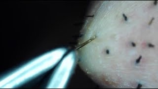 Plucking Facial Hair Extremely Close-up - Up Close Humans