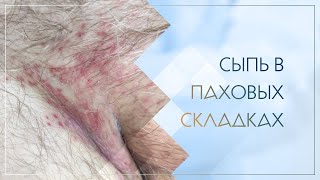 😲 Сыпь в паховых складках. Клинический случай №62