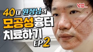 40대 원장님 모공성흉터 치료하기. Ep.2