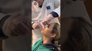 Removing external splint, 6 days after natural rhinoplasty by dr. Farshid Achak