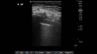 Pneumothorax