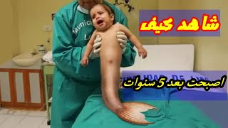 سخروا منها لأنها تشبه حورية البحر لكن شاهد كيف أصبحت بعد 5 سنوات أدهشت الجميع