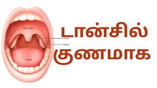 டான்சில்| Tonsillitis| தொண்டை அழற்சி| tonsils| strep throat| difficulty swallow| tender lymph nodes