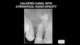 CALCIFIED CANAL WITH A MYSTERIOUS PERIAPICAL RADIO-OPACITY IN A MAXILLARY LATERAL INCISOR