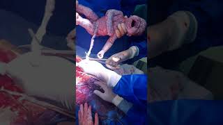 New PAS Conservation technique, Tourniquet before fetal extraction to reduce blood loss , EBL500cc👌