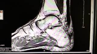 Achilles tendon rupture as seen on an MRI