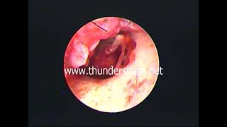 Endo tplasty ,ossicular chain- Dr.shreekantha acharya