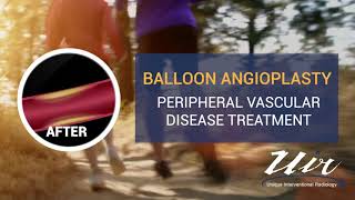 Peripheral vascular disease treatment │Unique Interventional Radiology