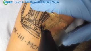 laser tattoo removal