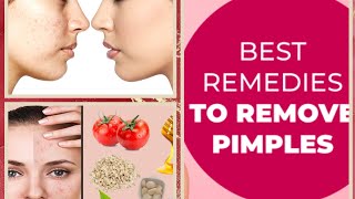 How to get rid of pimples | best home remedies to Remove pimples