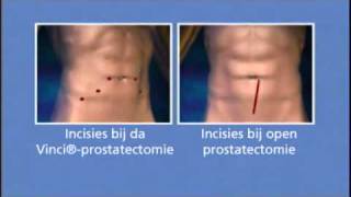 Voorlichtingsvideo da Vinci-prostatectomie