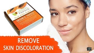 Remove Acne Scars, Dark Spots and Skin Discoloration with One Soap