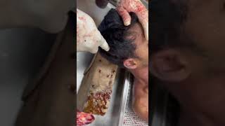 Applying Coronal Incision on Scalp