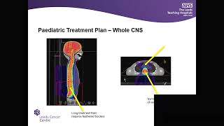 Pediatric Radiotherapy in Leeds – overview and clinical experience. Amy Bray