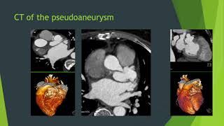 Complex Paravalvar Leak closure after Infective Endocarditis-Dr Malik demonstrates the techniques