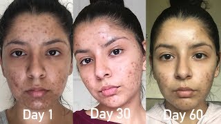 CURRENT SKIN CARE ROUTINE: HOW I'M CLEARING UP MY ACNE | Zoey