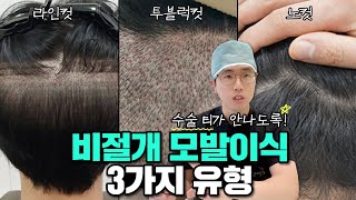 모발이식 비절개로 하려면 '삭발'해야 한다던데??? | 비절개 모발이식 컷트방법