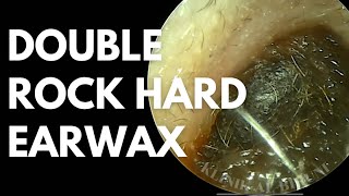 Double Rock Hard Earwax Extraction