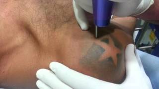 Rimozione Laser Tattoo dott. Picarella Messina