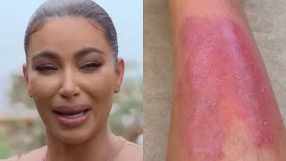 KIM KARDASHIAN SHARES VIDEO OF PAINFUL PSORIASIS FLARE UP