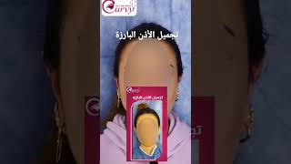 تجربتي مع تجميل الأذن البارزة د زين